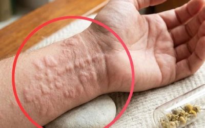 8 Surprising Hives Triggers You Might Be Overlooking