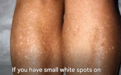 Why do I get white spots on my skin in the summer and how can I treat them? dermatologist answers.