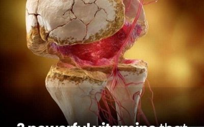 Top 3 Vitamins for Hip Arthritis