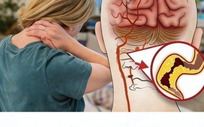 10 Early Warning Signs of a Stroke Everyone Should Know to Take Prompt Action